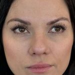 Full Facial Balancing Before & After Patient #919