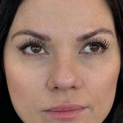 Full Facial Balancing Before & After Patient #919