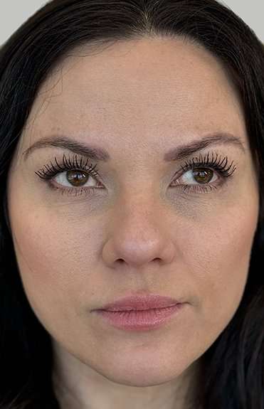 Full Facial Balancing Before & After Patient #919