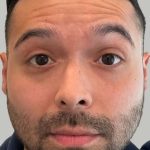 Botox/Dysport Before & After Patient #831