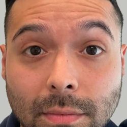 Botox/Dysport Before & After Patient #831