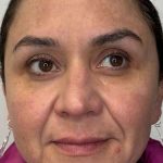 Full Facial Balancing Before & After Patient #924