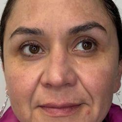 Full Facial Balancing Before & After Patient #924