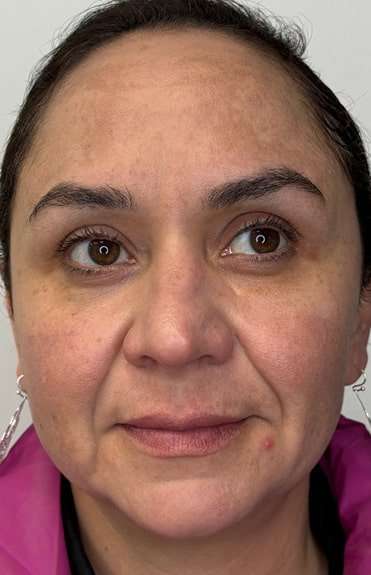 Full Facial Balancing Before & After Patient #924