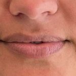Lip Filler Before & After Patient #927