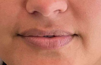 Lip Filler Before & After Patient #927