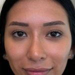 Lip Filler Before & After Patient #930