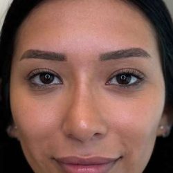 Lip Filler Before & After Patient #930