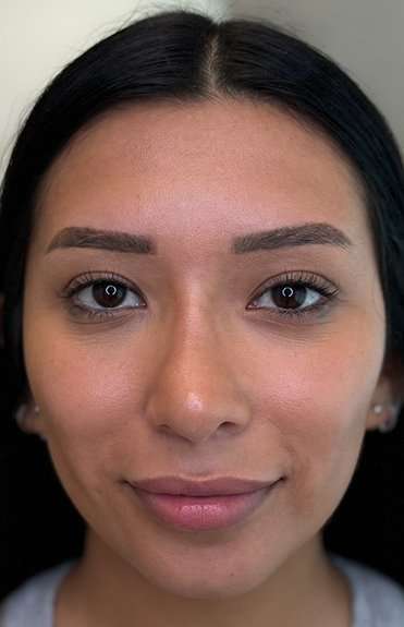 Lip Filler Before & After Patient #930