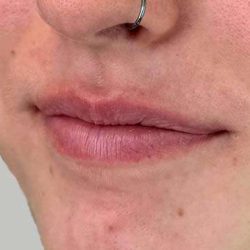 Lip Filler Before & After Patient #936