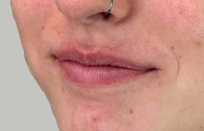 Lip Filler Before & After Patient #936