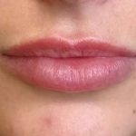 Lip Filler Before & After Patient #939