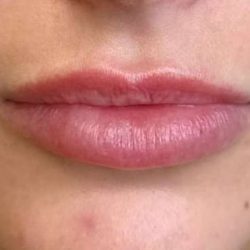 Lip Filler Before & After Patient #939