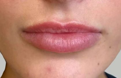 Lip Filler Before & After Patient #939