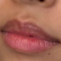 Lip Filler Before & After Patient #942
