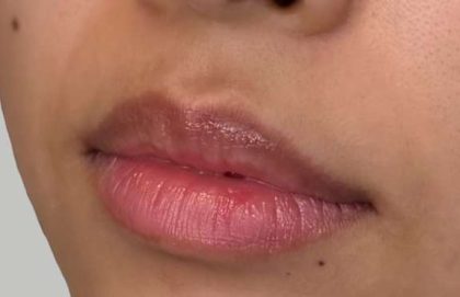 Lip Filler Before & After Patient #942