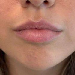Lip Filler Before & After Patient #945