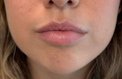 Lip Filler Before & After Patient #945