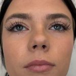 Lip Filler Before & After Patient #952