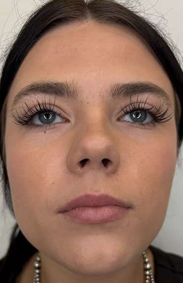 Lip Filler Before & After Patient #952