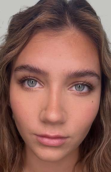 Lip Filler Before & After Patient #955