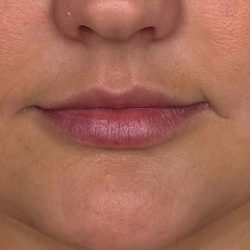 Lip Filler Before & After Patient #958