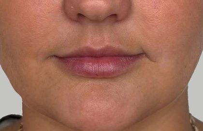 Lip Filler Before & After Patient #958
