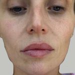 Lip Filler Before & After Patient #965