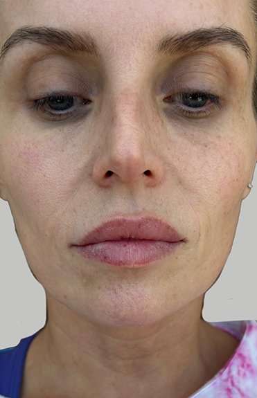 Lip Filler Before & After Patient #965