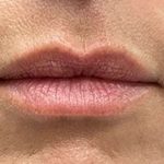 Lip Filler Before & After Patient #968
