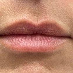 Lip Filler Before & After Patient #968