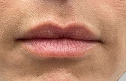 Lip Filler Before & After Patient #968