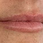 Lip Filler Before & After Patient #971