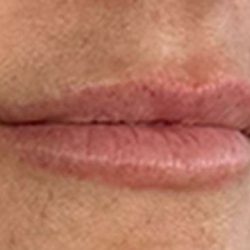 Lip Filler Before & After Patient #971