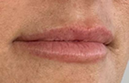 Lip Filler Before & After Patient #971