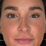 Lip Filler Before & After Patient #981