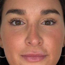 Lip Filler Before & After Patient #981