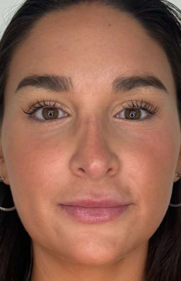 Lip Filler Before & After Patient #981