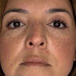 Lip Filler Before & After Patient #984