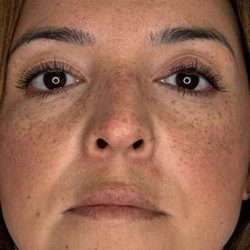 Lip Filler Before & After Patient #984
