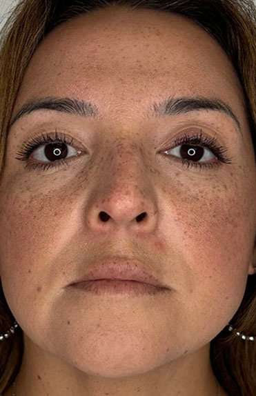 Lip Filler Before & After Patient #984