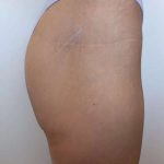 Non-Surgical BBLs Before & After Patient #987