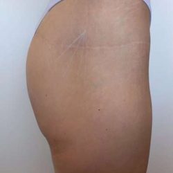 Non-Surgical BBLs Before & After Patient #987