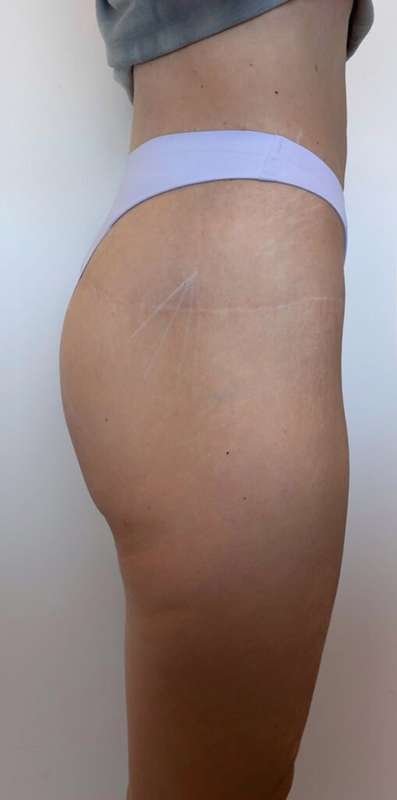 Non-Surgical BBLs Before & After Patient #987