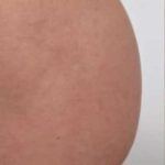 Non-Surgical BBLs Before & After Patient #990