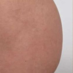Non-Surgical BBLs Before & After Patient #990