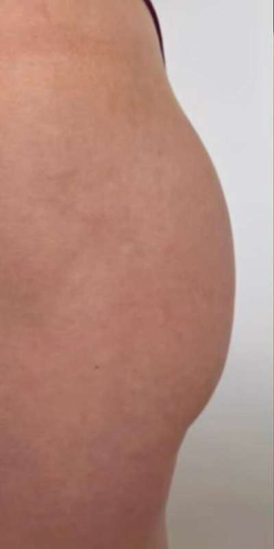 Non-Surgical BBLs Before & After Patient #990