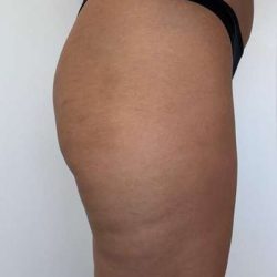 Non-Surgical BBLs Before & After Patient #993