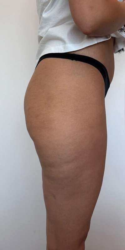 Non-Surgical BBLs Before & After Patient #993