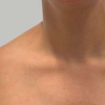 Botox/Dysport Before & After Patient #837